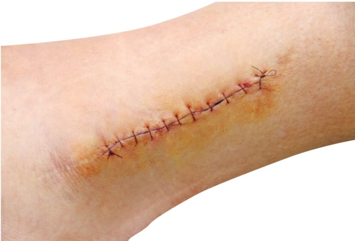 laceration